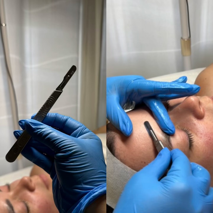 Aplicación de dermaplaning en Aire Puro Skinn